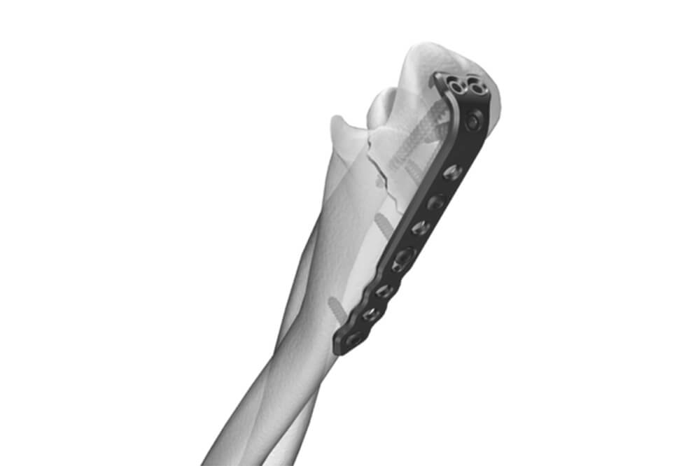 1.5mm-Cortical-Screws,-Mini-system